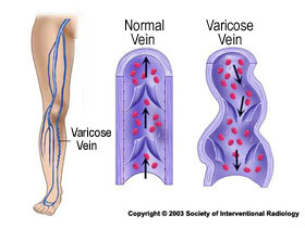 Vericose Veins - The Vein Treatment Center