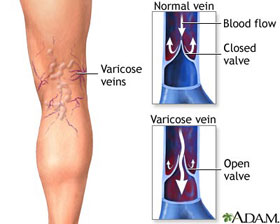 Vericose Veins - The Vein Treatment Center